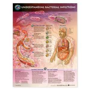 Understanding Bacterial Infections Anatomical Chart Unmounted 9774PU